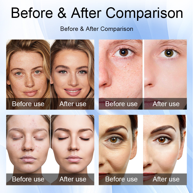 11Professional Nano Mesotherapy Sprayer for Skin Rejuvenation